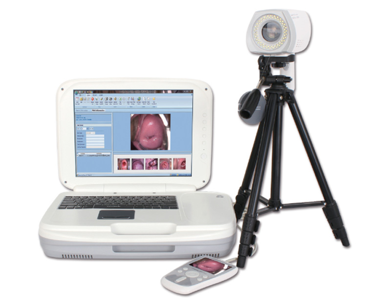 HD Digital Electronic Colposcope