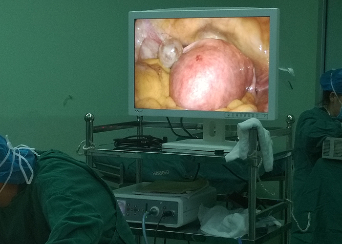 【Gynecological Laparoscopy】Laparoscopic cholecystectomy