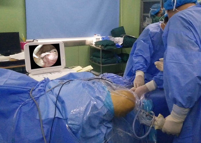Application Of Arthroscopy In The Lysis Of Knee Joint Adhesions