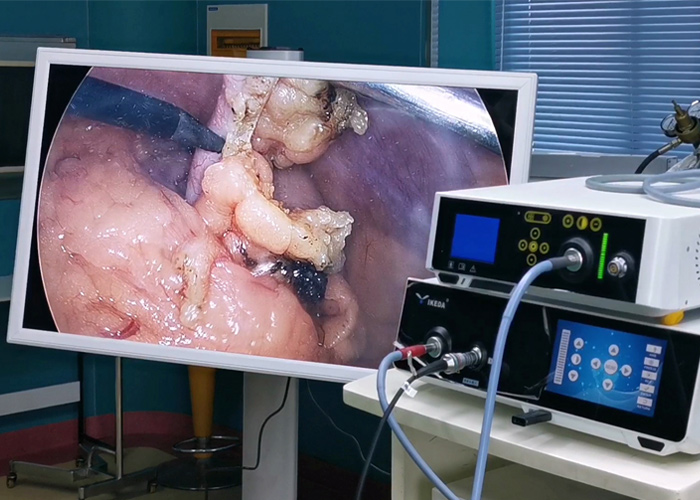 Application of combined hysteroscopy and laparoscopic surgery in gynecology