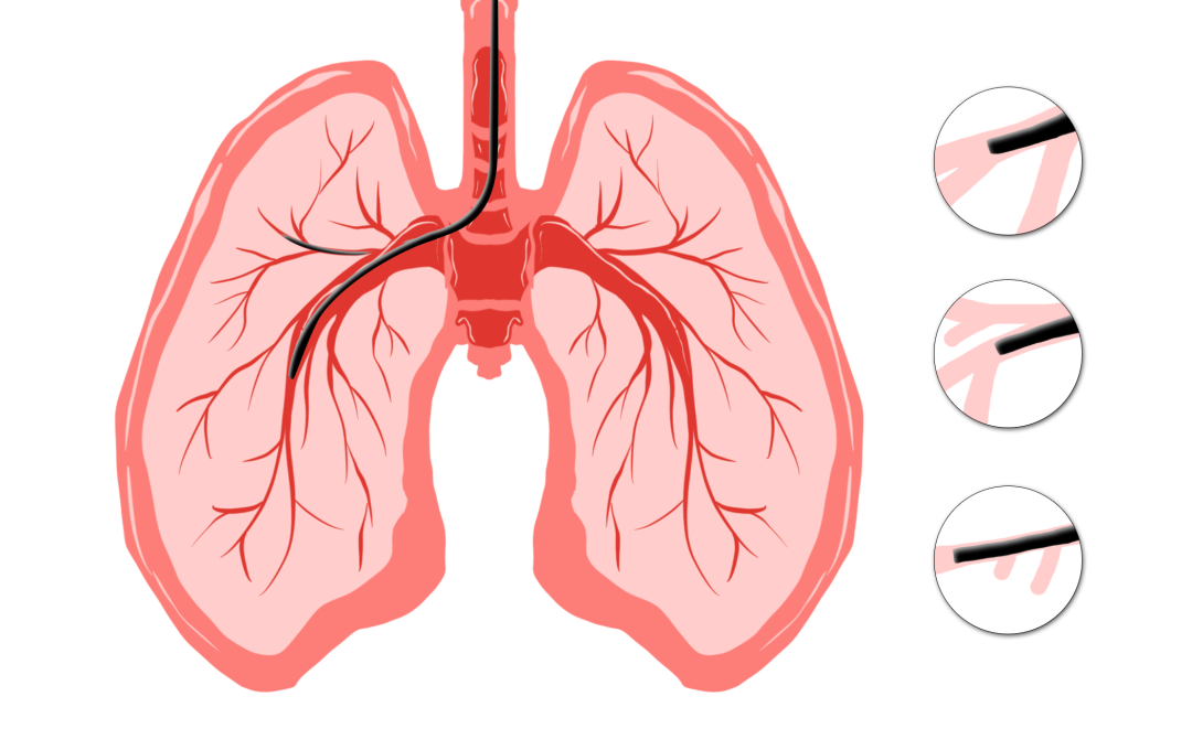 What is a normal bronchoscopy procedure