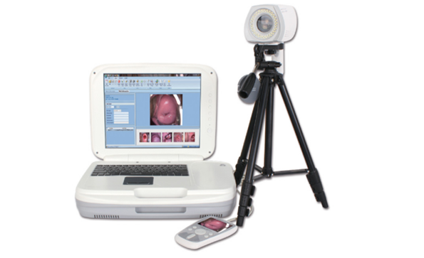 Indication of HD Digital Electronic Colposcope