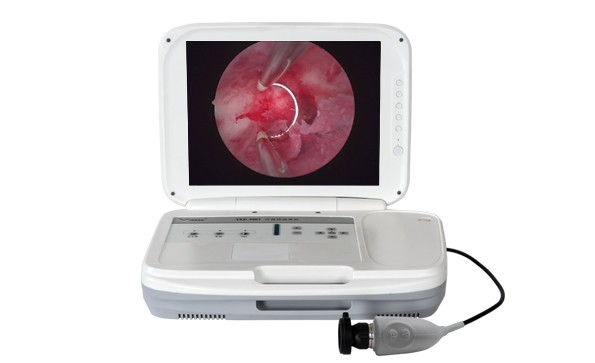 【Hysteroscopy】Resection of endometrial polyps under hysteroscope