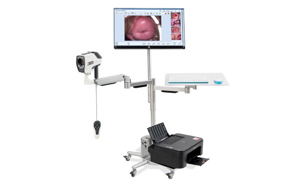 The application of digital electronic colposcopy can reduce the occurrence of cervical cancer