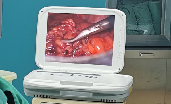 【Laparoscopy】Laparoscopic appendectomy