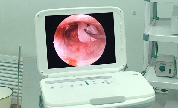 Application Of Ear Endoscope In Tympanic Membrane Repair