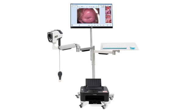 Application of colposcopy in diagnosis of cervical cancer