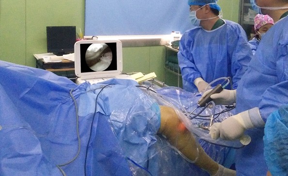 Arthroscopy Lysis For The Treatment Of Knee Joint Adhesions