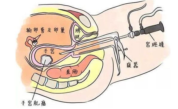 Hysteroscopic findings of normal uterine cavity