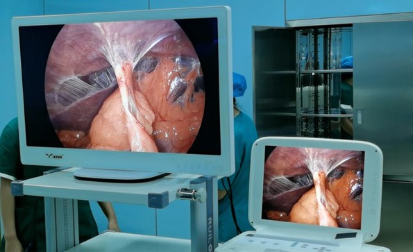 Clinical application of medical HD endoscope camera system (laparoscope)