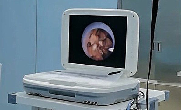 Application of endoscope camera in urology (ureteroscope)