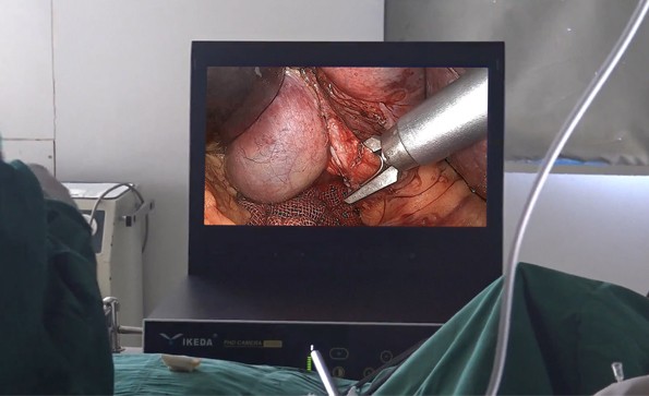 Laparoscopic procedure