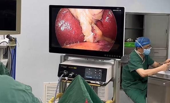 The Advantages Of 4K Medical Endoscope Camera System in Cholecystectomy