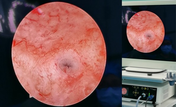 Application of HD endoscopic camera in hysteroscopic surgery